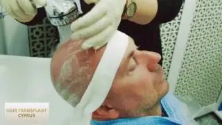 Hair Transplant Cyprus