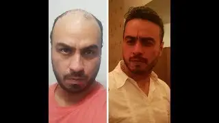 PROTESI CAPELLI 5 ERRORI DA NON COMMETTERE (ITALIANO TUTORIAL)