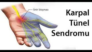 Bilekte Sinir Sıkışması, Karpal Tünel Sendromu