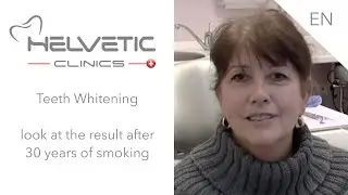Whitening - look at the result after 30 years of smoking! - Helvetic Clinics, Aesthetic Dentistry.