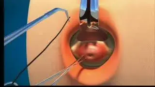 Dr Panicker's Cerclage Using Special Instruments in French