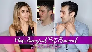 SculpSure Fat Melting Treatment | After 3 Months Results Show