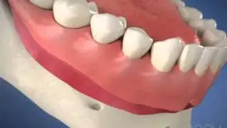 Dentures: Denture Problems