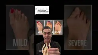 Can You Avoid A Bunion?
