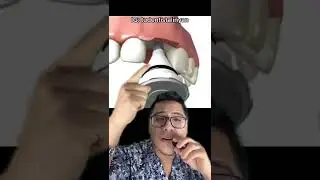MuelinFlash #48: &iquest;Qu&eacute; son los implantes dentales?  🦷🧑🏻&zwj;⚕️🎤