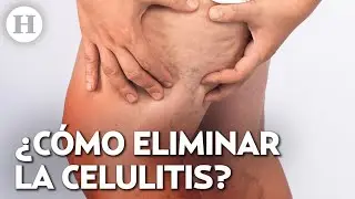 ¡La celulitis también da a hombres! Dermatóloga explica que la provoca y cómo eliminarla de tu piel
