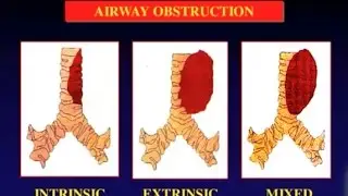 Choosing Between Endoluminal Ablation Therapies