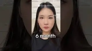 Korean Double Jaw Surgery + V-Line Surgery Results | (Before & After)