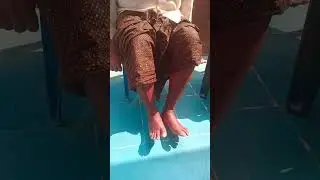 diabetic neuropathy and varicose veins , numbness legs pain management control with in 10minits live