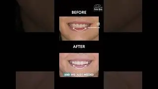 Invisalign treatment #dentalclinic #стоматология #dubai #дубай #invisalign #стоматолог #dentist