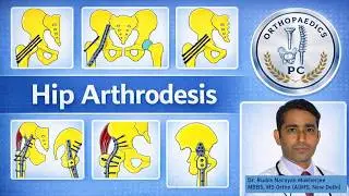 Hip Arthrodesis