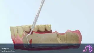 Medical animation:  Tooth extraction