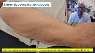 Needle EMG: fasciculations