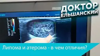 Липомы и атеромы в чем отличия