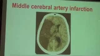 Advances in Brain Treatment