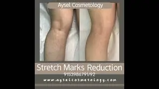 Leg Stretch Marks Reduction.