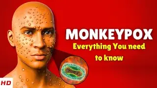 What is Monkeypox? Causes, Signs and Symptoms, Treatment & Prevention