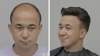 PROTEZ SA&Ccedil; UYGULAMASI - Hair Replacement