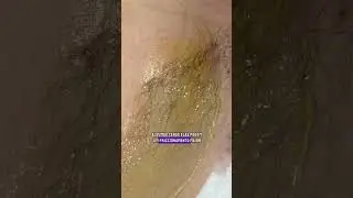 Como N&atilde;o Errar na Depila&ccedil;&atilde;o no M&eacute;todo Hidrossol&uacute;vel