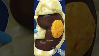 Robotic partial nephrectomy surgery (3D animation) #music #motivation #epic #like #subscribe #reels