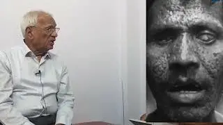 #Dr. Mohammad Athar Ansari (Ms) #MONKEYPOX #WHO #Monkey poxvirus