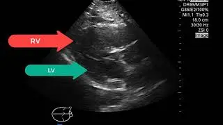 Right Heart Strain on bedside ultrasound