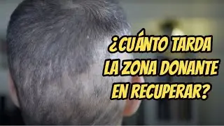 Trasplante capilar en España, día 70, ¿Se va a recuperar mi zona donante?