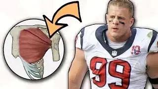 Doctor Explains JJ Watt PEC TEAR | Another Season Ending Injury!
