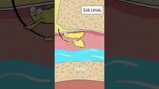 Why Exactly Does Water Get Trapped in the Ear After a Bath