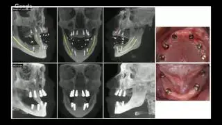 Digital Smile Design Integration With  Blue Sky Plan (Dr Marko Tadros)