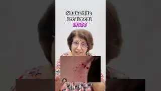 snake bite treatment #subscribe #life #india