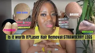 Laser Removal  Strawberry Legs.. HMm..Is it Worth the 