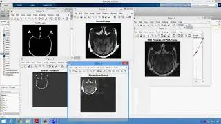 Implementation of Medical Image Fusion Using DWT Process on FPGA in Matlab