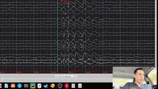 EEG with Frontal Spike & Wave Discharges