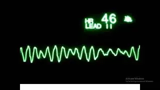 How to read ECG Episode 1 by Dr Ahmed Elshatory MD Clinical Toxicology