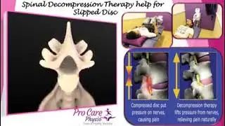 Slipped Disc Treatment
