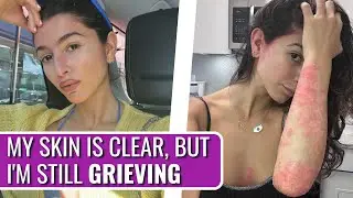 I Couldn't Stop Scratching! - Alana | Psoriasis & Psoriatic Arthritis | The Patient Story