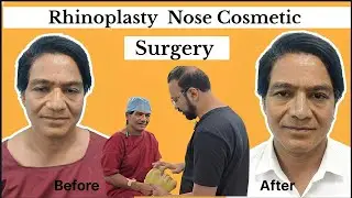 Rhinoplasty In Delhi | Rhinoplasty Nose Surgery In Delhi | Zenith Clinic