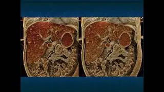 CT Evaluation of Hepatic Masses: A Focused Approach to Signs and Enhancement Patterns - Part 4