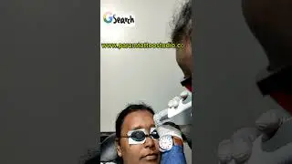 FOREHEAD BINDI TATTOO REMOVAL #tattooremoval #foreheadbinditattooremoval