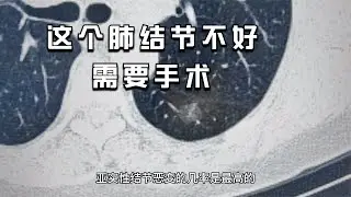 體檢發現1.5cm亞實性結節，醫生：這個結節不好，需要手術