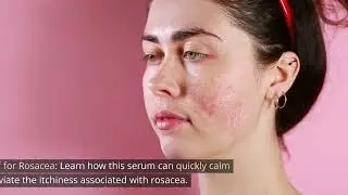 Skinception&trade; Rosacea Relief Serum Review | Immediate & Long-Term Relief
