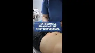 Carbossiterapia post gravidanza?