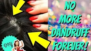 DANDRUFF SHAMPOO TREATMENT!! [DIY]  |SolutionsRoom|
