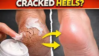 &ldquo;Cracked Heels Cream That ACTUALLY Works | Heal Deep Cracks Fast at Home&rdquo;