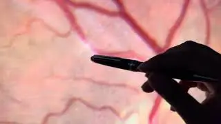We Are Looking At A Small Retinal Artery With A Cholesterol Plaque