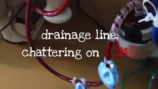 chattering on ECMO