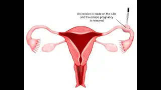 Salpingostomy, Salpingotomy, Salpingectomy; surgical procedures involving the fallopian tubes