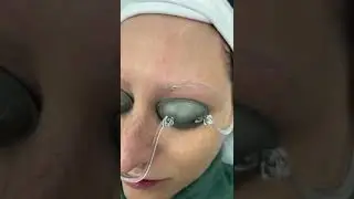 Why do brows go white after laser tattoo removal?
