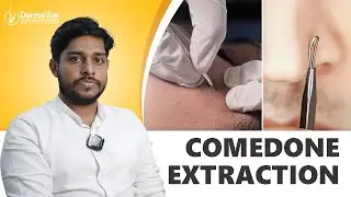 Understanding and Treating Blackheads and Whiteheads: No more Comedones #malayalamhealthtips
